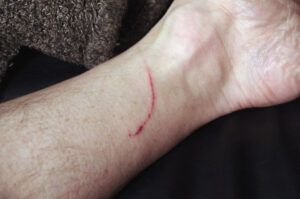 Cat scratch on a leg